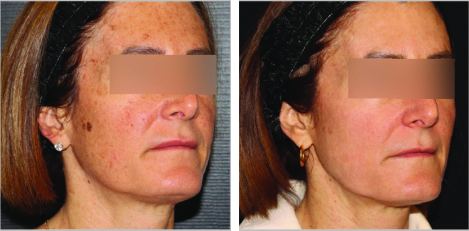 BBL HEROic + Moxi, 3 months after 3 treatments