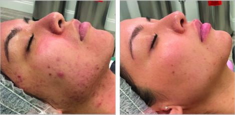 Moxi, 6 months after 1 treatment
